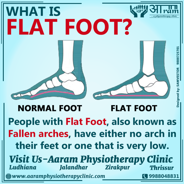 Flat feet